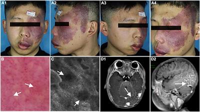 Whole-Genome Sequencing Identified KCNJ12 and SLC25A5 Mutations in Port-Wine Stains